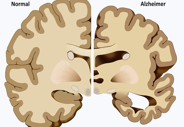 complicaciones de la enfermedad de Alzheimer