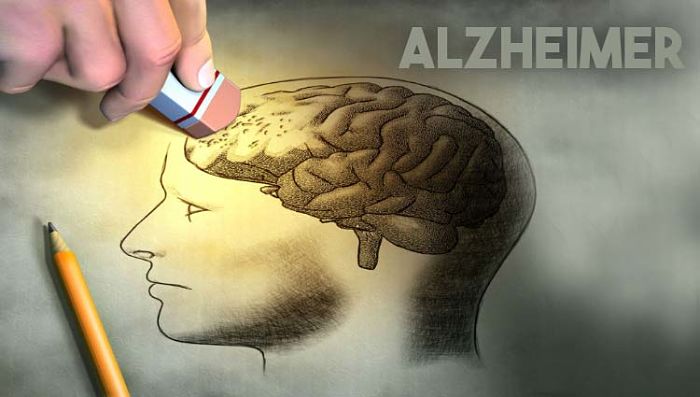 enfermedad de Alzheimer